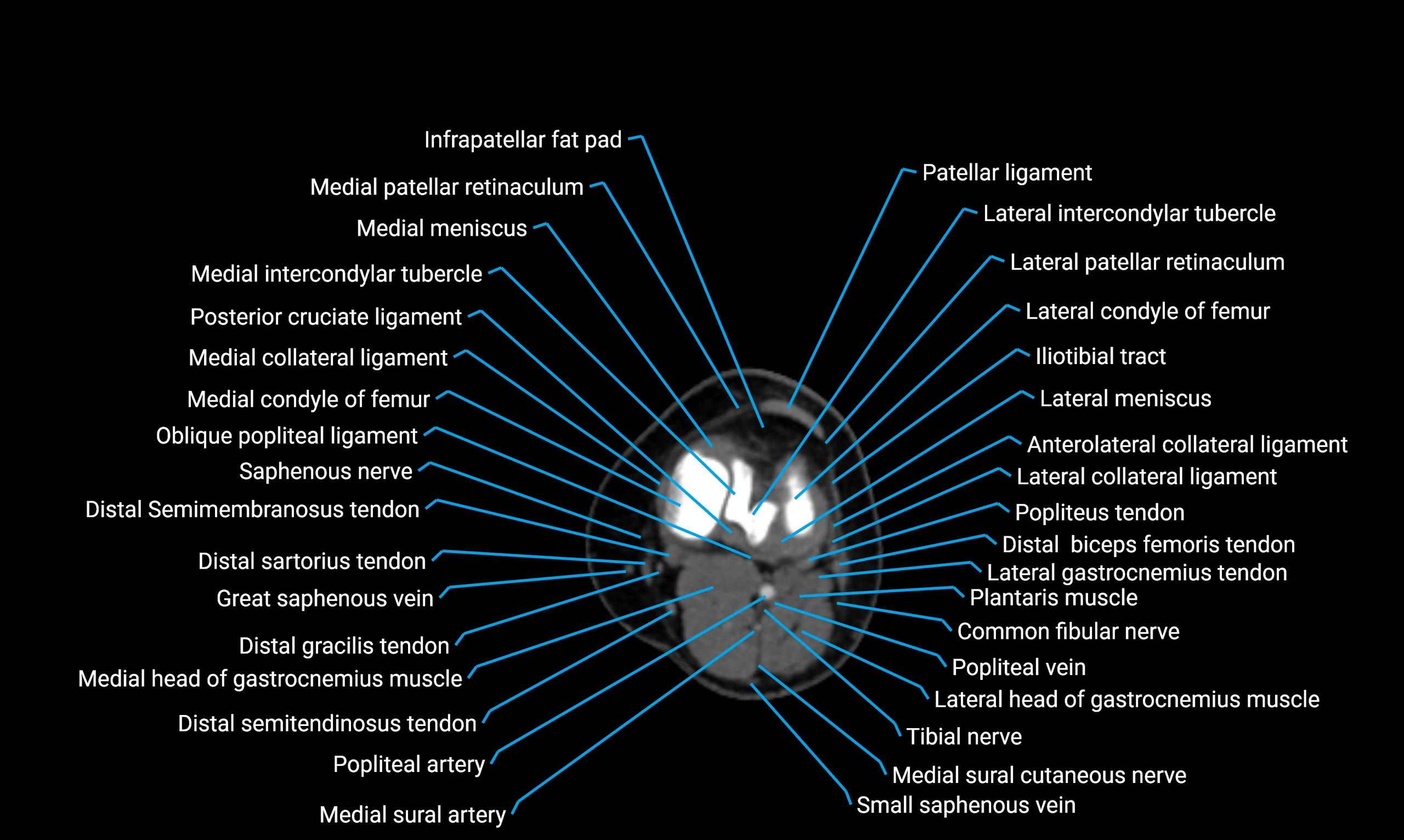CT lower limb axial cross sectional anatomy labelled image 90 (2).webp